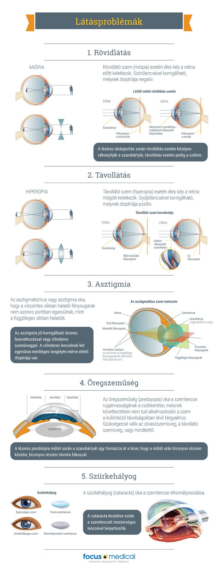 éles látásgyakorlat akiknek javult a látás a testmozgástól